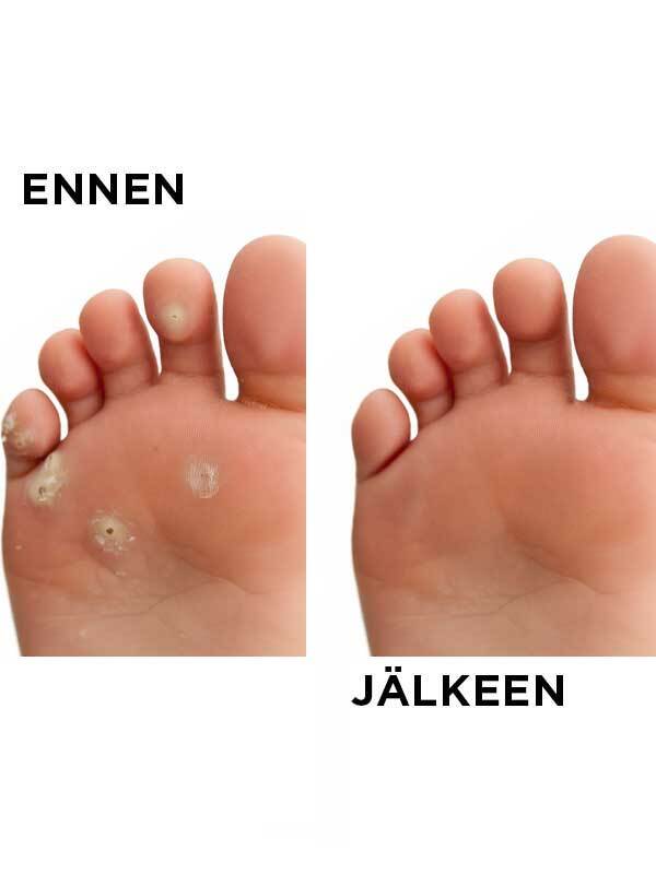 Elektrokoagulointilaite - Image 4