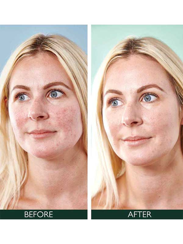 Sorted Skin Anti-Redness 5 in 1 Day Cream 30ml - Image 3