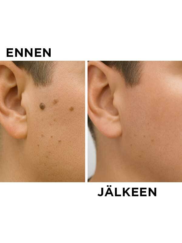 Elektrokoagulointilaite - Image 3