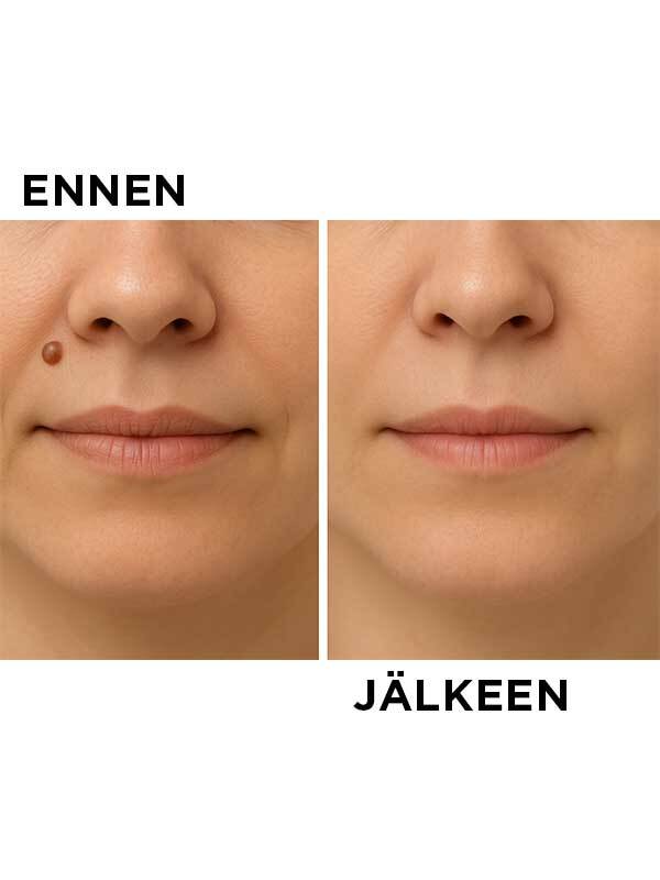 Elektrokoagulointilaite - Image 2