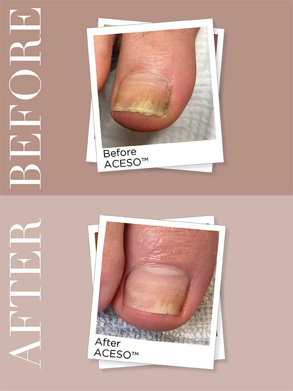 Aceso Step 1 kynnelle 60 ml - Image 3