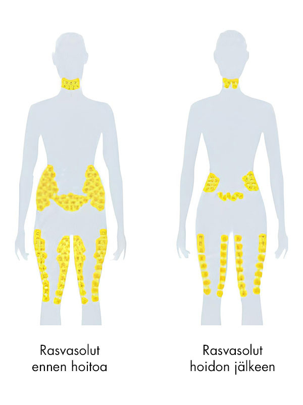 Scandinavian Skin Cryolipolyysi - Image 3