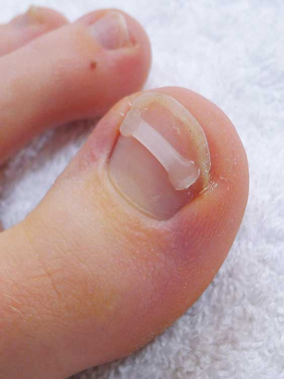 PODOSTRIPE-kynnenoikaisuliuska XS, 8 kpl - Image 3