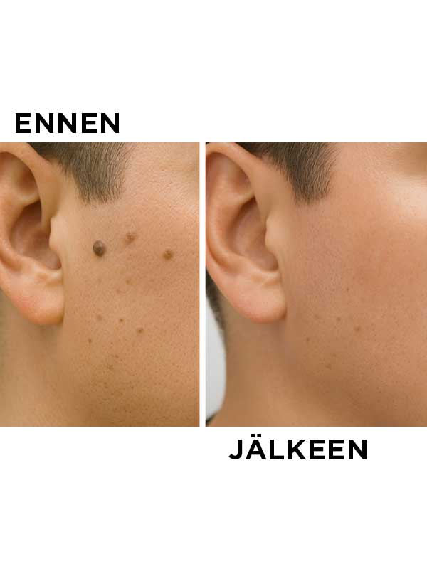 Elektrokoagulointilaite - Image 3