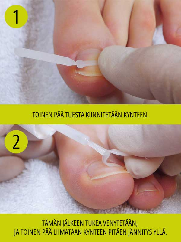 PODOSTRIPE-kynnenoikaisuliuska M, 8 kpl - Image 4