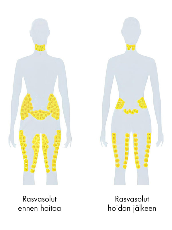 Scandinavian Skin Cryolipolyysi - Image 3