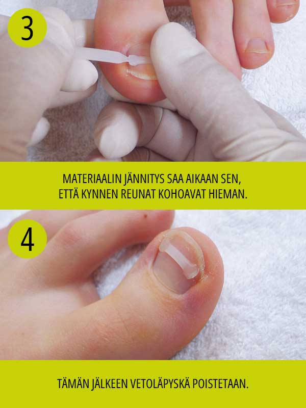 PODOSTRIPE-kynnenoikaisu setti - Image 4