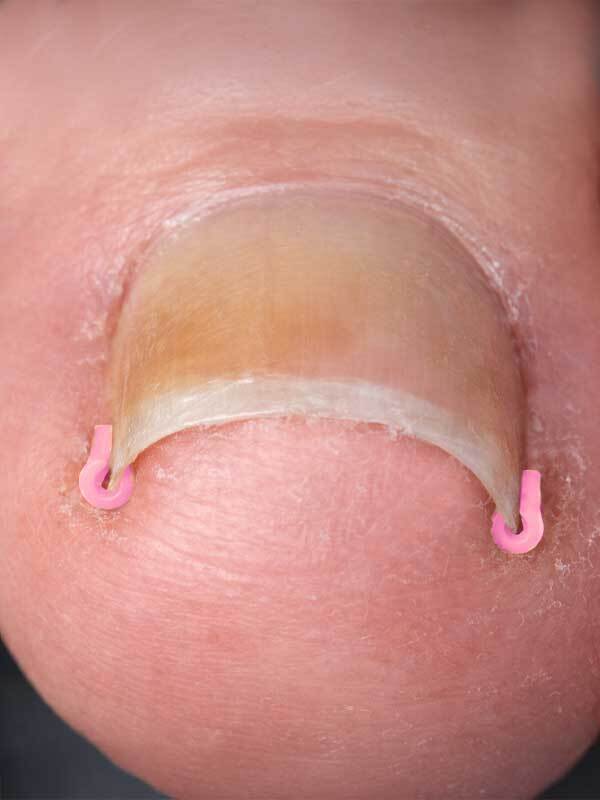 Suojaholkki koko M pinkki 100 kpl - Image 2