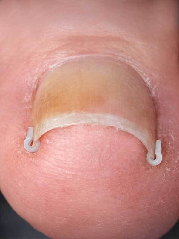 Suojaholkki koko S valkoinen 100 kpl - Image 2